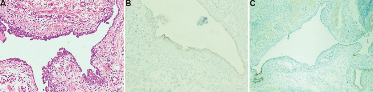(A) High-power photomicrograph (H and E, ×100) showing a flat layer of mesothelial cells lying on a loose fibrous stroma. (B) High-power photomicrograph (×100) with D2-40 immunohistochemical staining showing D2-40 expression by the neoplastic cells which outline the shape of the cysts. (C) Low-power photomicrograph (×40) with calretinin immunohistochemical staining showing calretinin expression by the neoplastic cells which outline the shape of the cysts.